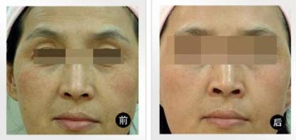 超声时光系统除皱前后对比图