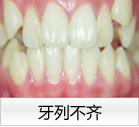 牙列不齐